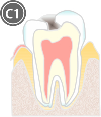 虫歯の進行度と治療法_C1