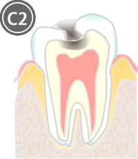 虫歯の進行度と治療法_C2