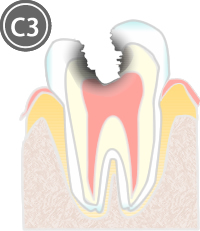 虫歯の進行度と治療法_C3