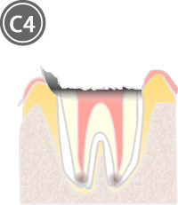虫歯の進行度と治療法_C4