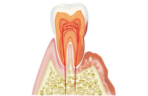 歯周病＿歯茎が痩せる